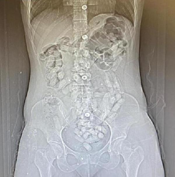 İranlı 2 kadının midelerinden 693,3 gram Afyon sakızı çıktı