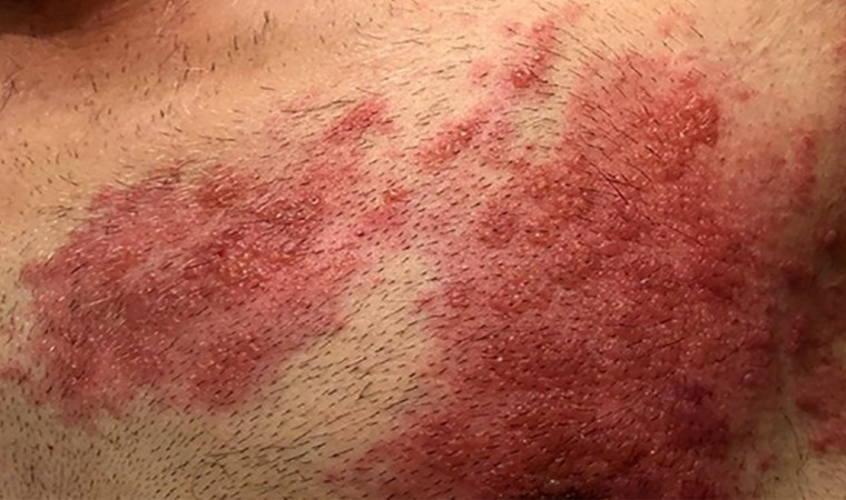 Covid-19 salgını sonrası viral hastalıklar coştu: Kızamık ve Zonaya dikkat