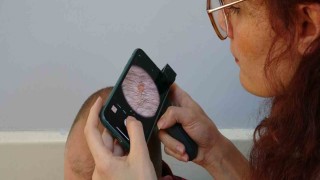 Uzmanlar uyardı: Ciltteki benler kansere dönüşebilir