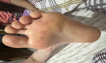 Çocuklarda artan el ayak ağız hastalığına dikkat: Uzmanlar tatilde ortak kullanılan alanlara karşı uyardı