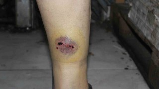 Sokak köpeğinin saldırdığı vatandaş yaralandı