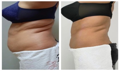 Tek seansta 3.5 santim incelme mümkün