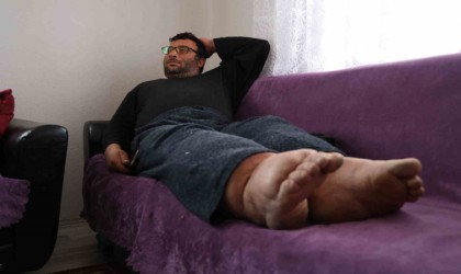 Bacakları 80 santimetre çapına ulaştı, hastalığın tedavisi yok