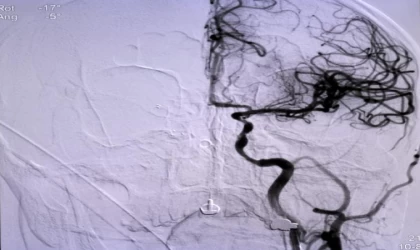 İnmede erken müdahale hayat kurtarıyor