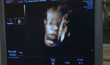 Türkiyede 2021 yılında 32 bin olan HIV pozitif hasta sayısının, 2 kat fazla olduğu değerlendiriliyor