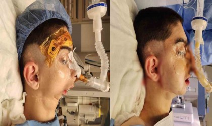 Doğuştan alt çenesi olmayan çocuğa başarılı operasyon: 17 yıl sonra normal yemek yiyebilecek