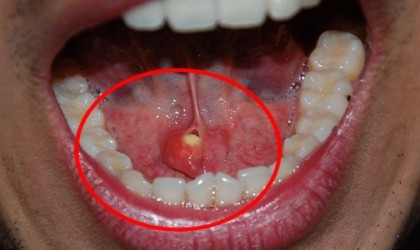 Sessiz tehlike ağızda gizleniyor