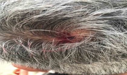 Ceviz büyüklüğündeki dolu vatandaşın kafasını yardı