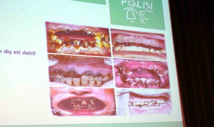 Metamfetamin kullanan bağımlıların ağız ve dişleri görenleri korkuttu
