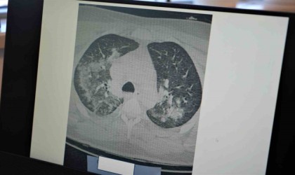 Profesör Özkaya: Kalp krizi vakalarının sebebi Kovid-19 olabilir