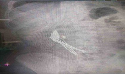 Çocuğun midesinden çıkanlar şaşırttı