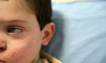 Yüzünün sol tarafı felç olan 4 yaşındaki Buraka akupunktur tedavisi umut oldu